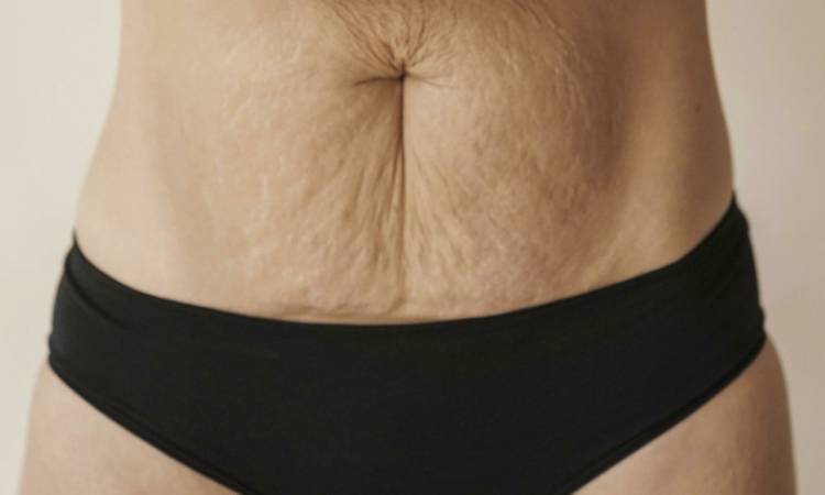 7 cách khắc phục da bụng chảy xệ sau giảm cân